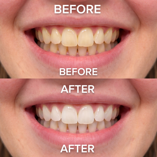 Antes y despues del blanqueamiento dental