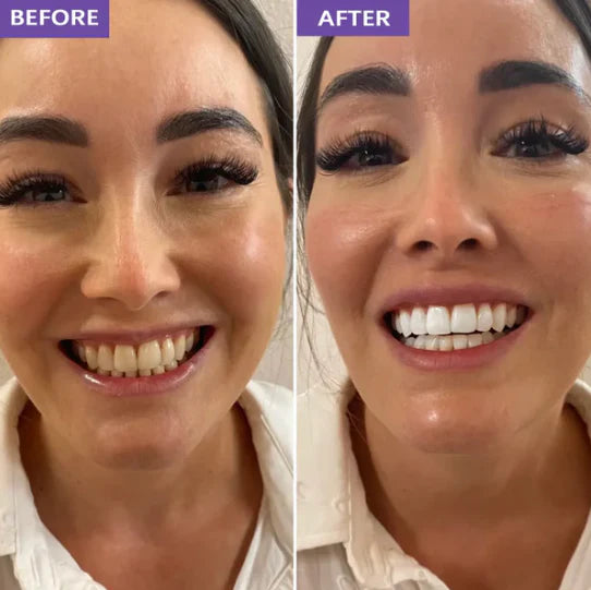 Sonrisa antes y despues con tiras blanqueadoras