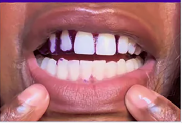 Resultado en dientes superiores