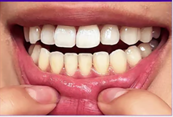 Comparacion de dientes tras el uso