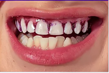 Dientes superiores mas blancos