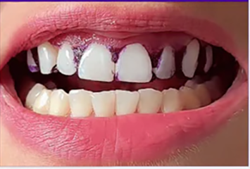 Resultado del blanqueamiento dental
