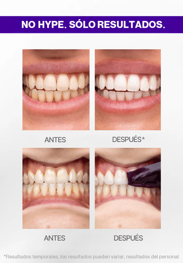 Antes y despues con las tiras blanqueadoras moradas